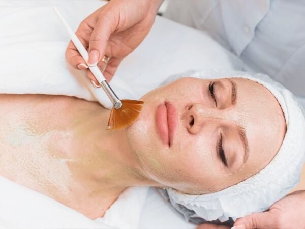 Chemical peel